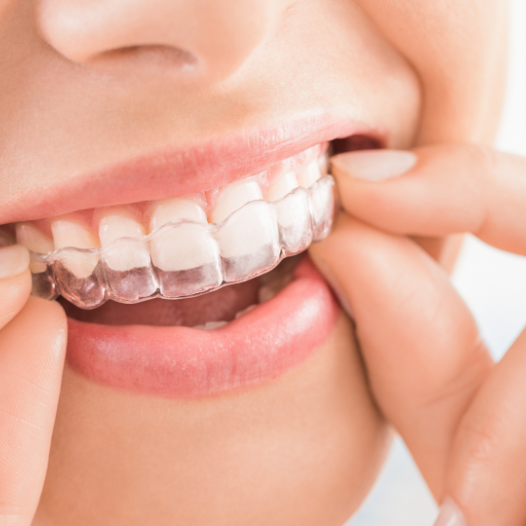 forniture dentali RETRATTORE OCCLUSALE PER FOTO CON